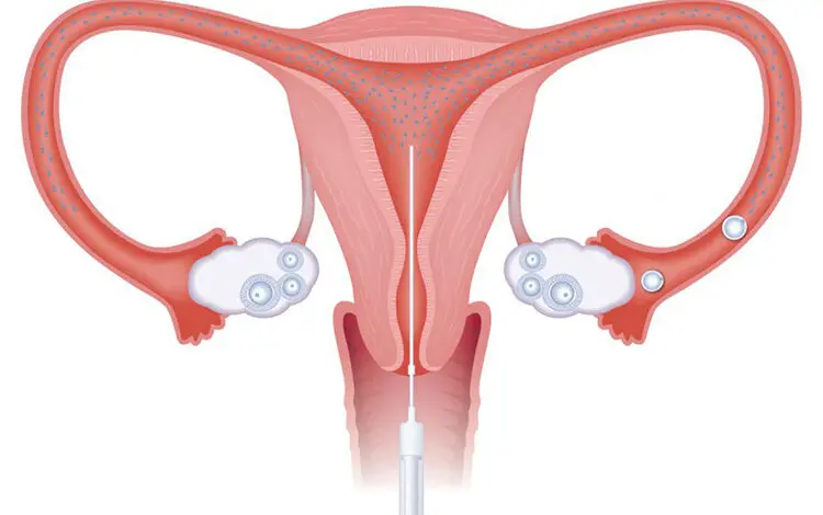 Aşılama Tedavisi (IUI)